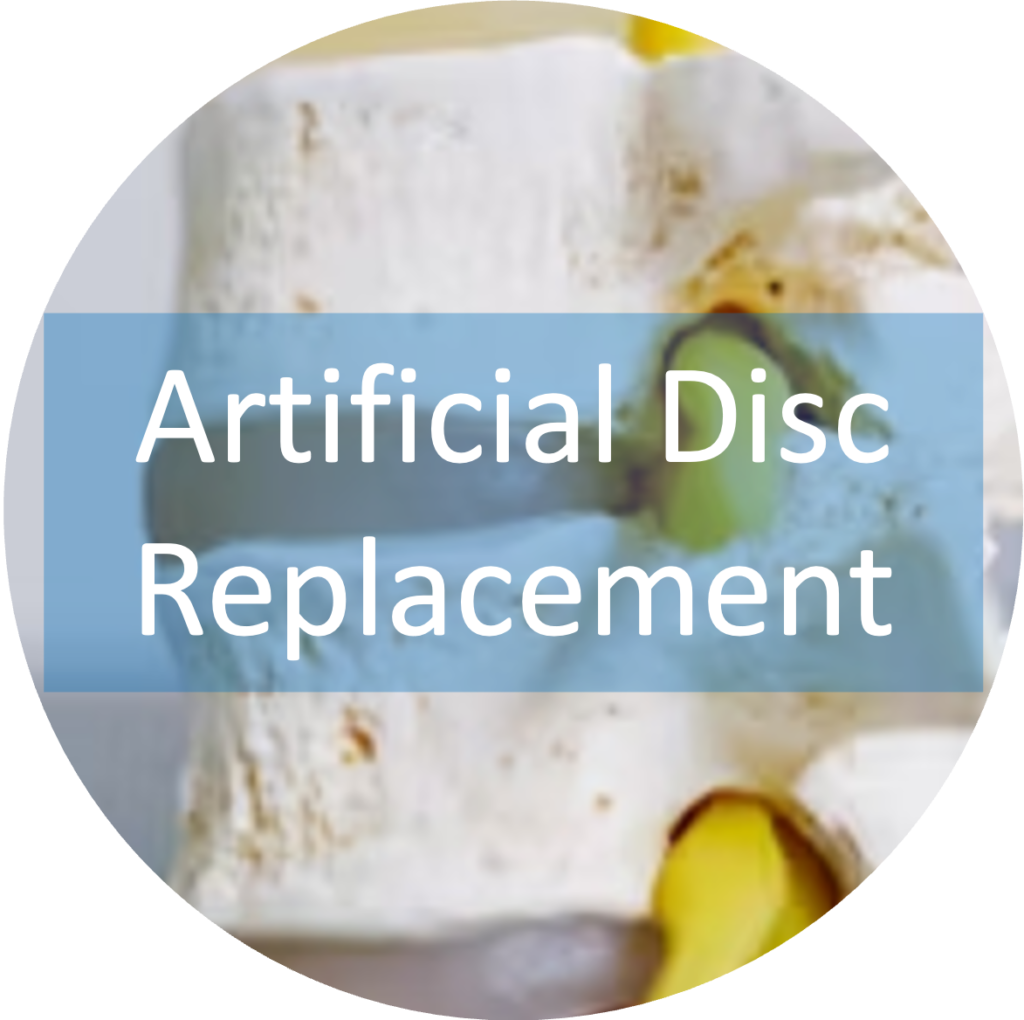 Artificial Disc Replacement