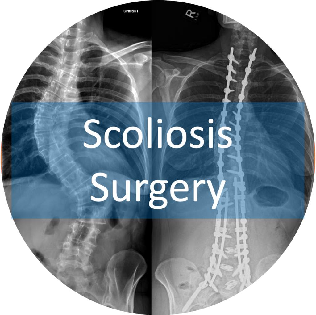 Scoliosis Surgery