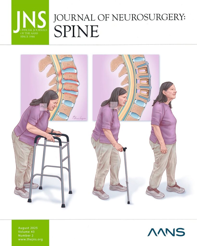 Journal of Neurosurgery: Spine — August 2025